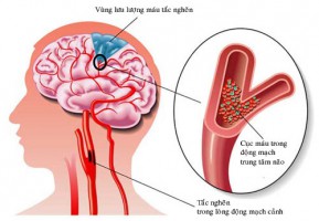 Động mạch nối trực tiếp não chính là mạch máu dễ bị tắc nghẽn nhất!
