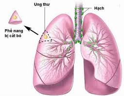 Máy 'ngửi' hơi thở phát hiện ung thư phổi